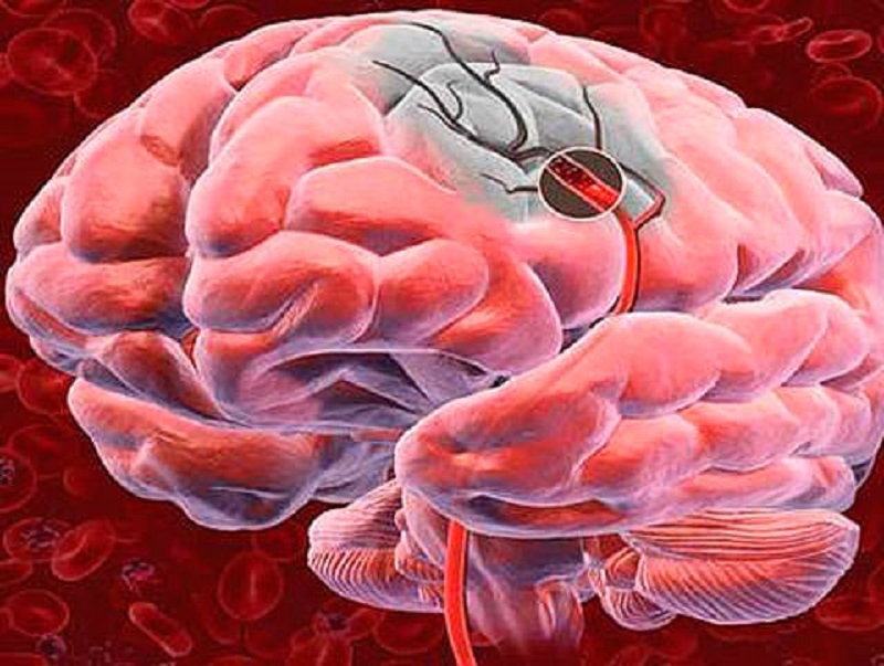  علائم لخته شدن خون در مغز 