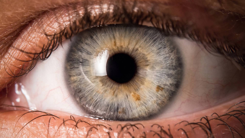 علل به وجود آمدن آب سیاه چشم چیست؟+علائم