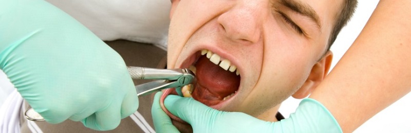 آیا کشیدن دندان عقل لازم است؟