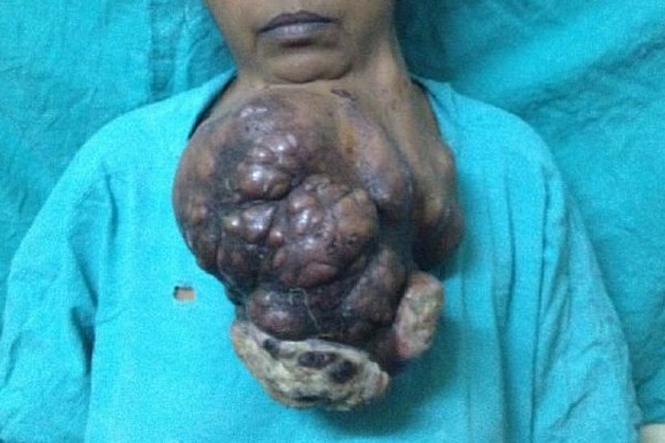 تومور ۵ کیلویی در چانه یک هندی + عکس