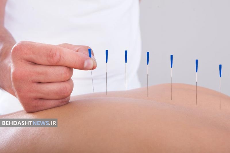  کاهش استرس بدن با طب سوزنی 