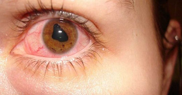  قوز قرنیه چیست و چه کسانی را گرفتار می‌کند؟
