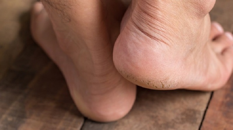  درمان خانگی زبری و ترک کف پاها 