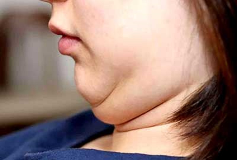  چگونه چربی اطراف صورت را بسوزانیم؟