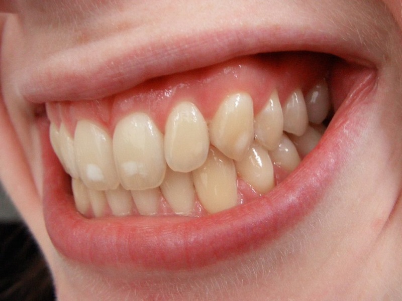 علت لکه های سفید روی دندان + ۱۱ راه درمان