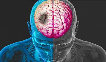 چرا سن سکته مغزی پایین آمده است؟