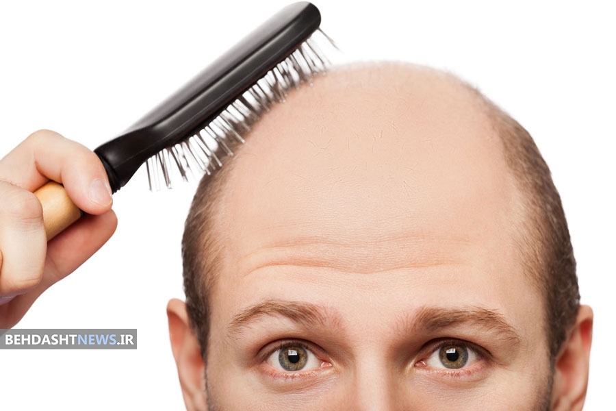کدام ریزش مو برگشت‌پذیر است؟ 
