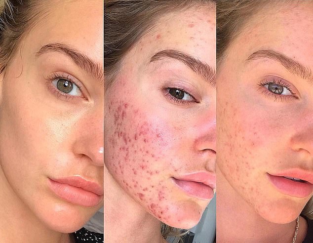  پوست خرابی که رژیم غذایی نجاتش داد + عکس 