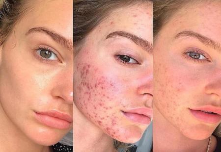  پوست خرابی که رژیم غذایی نجاتش داد + عکس 
