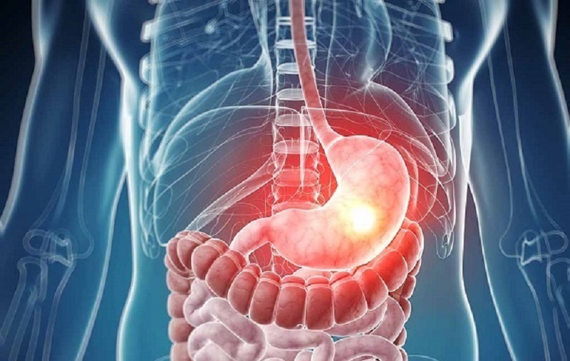  نسخه بسیار قوی طب سنتی برای درما ن زخم معده