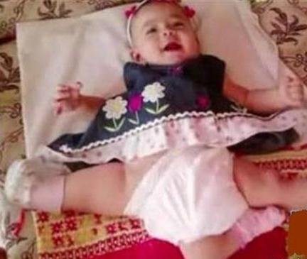 نوزادی که مجبور بود با ۳ پا زندگی کند+تصویر