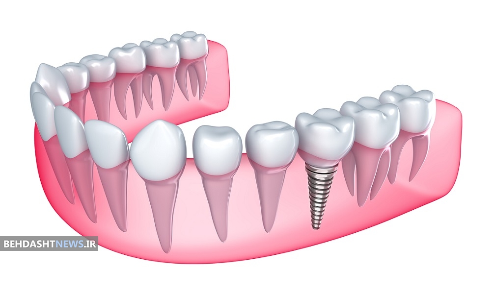 چه افرادی برای استفاده از ایمپلنت محدودیت دارند؟ 