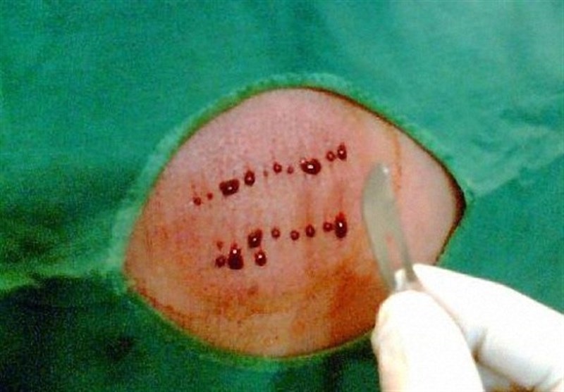  اثر درمانی  حجامت  را با رعایت این تدابیر چند برابر کنید 