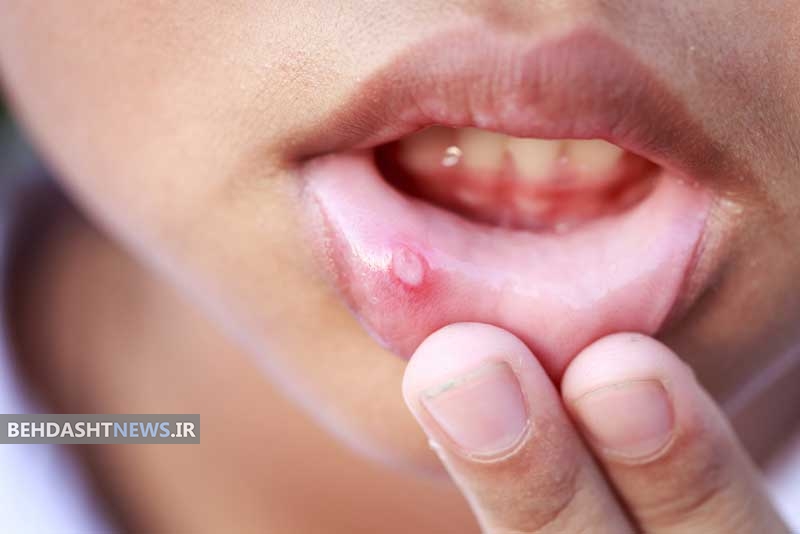 چگونه به سرعت از شر آفت های روی زبان خلاص شوید