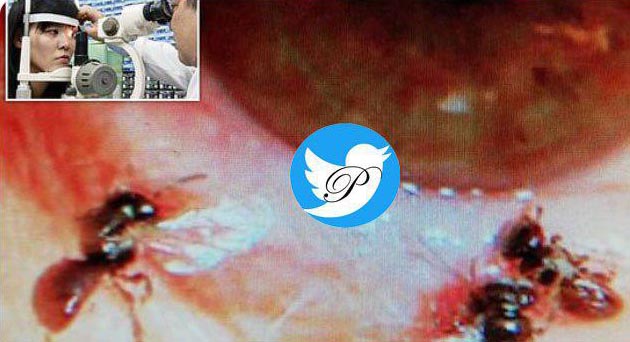 کشف ۴ زنبور زنده داخل چشم یک خا‌نم! + عکس