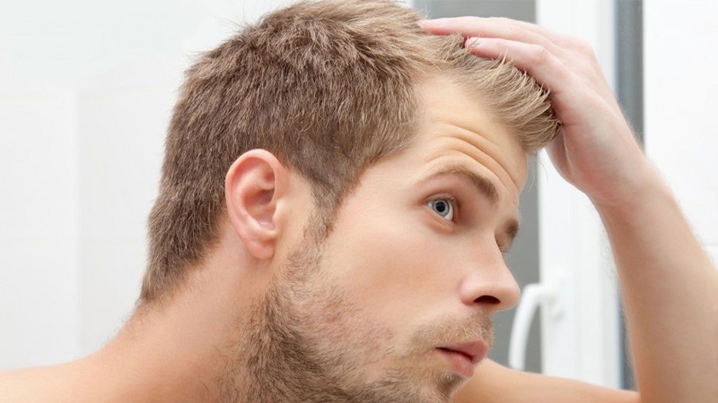 دلایل غیر ارثی ریزش مو