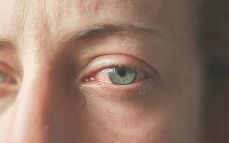 خشکی و قرمزی چشم می تواند نشانه ای از این بیماری باشد