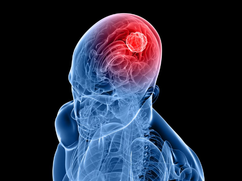 نشانه‌های اولیه سرطان مغز