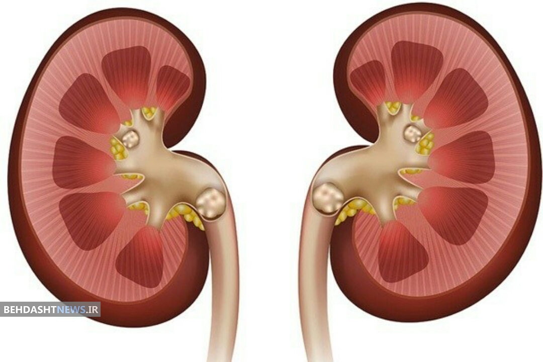 آیا با یک کلیه می‌شود بدون مشکل زندگی کرد؟