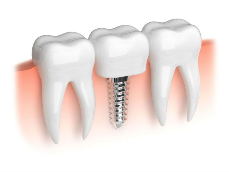 خطرات کوتاه و بلند مدت ایمپلنت‌های دندان