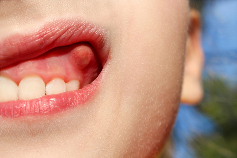 بیماری‌های عفونی دهان و دندان زمینه‌ساز چه بیماری‌هایی است؟
