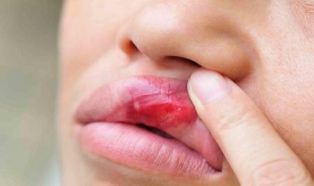 ضایعات دهانی علامت کدام بیماری است؟