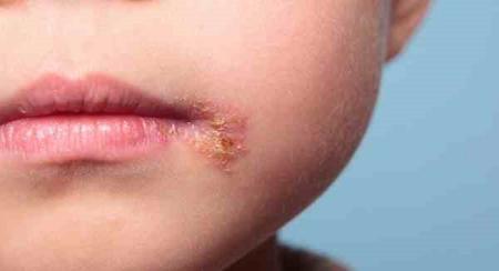 زردزخم چیست؟ آشنایی با علائم بیماری و روش های درمان