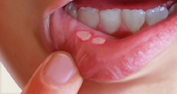  ۷ نسخه طبیعی برای درمان فوری آفت دهان