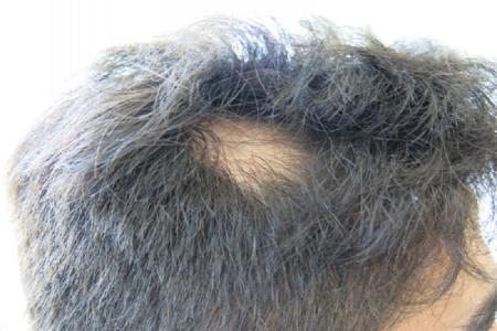  راهکار طب‌سنتی برای ریزش موی سکه‌ای +علل ابتلا به آلوپسی آره آتا