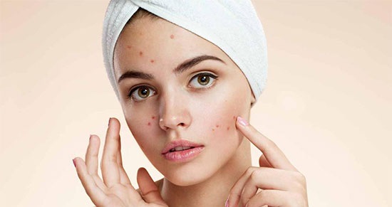 چگونه می‌توانیم به درستی از شر جوش و آکنه خلاص شویم؟