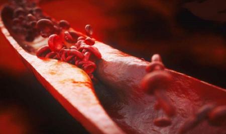 گرفتگی عروق قلب را با این معجون طبیعی برطرف کنید
