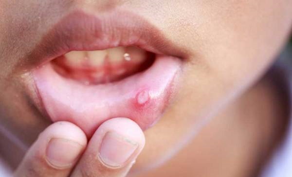  7 درمان خانگی برای آفت دهان و تبخال 