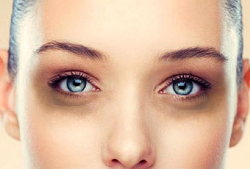  یک ترکیب جادویی برای سیاهی دور چشم
