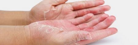  اگزما گریبانگیر چه کسانی می‌شود؟