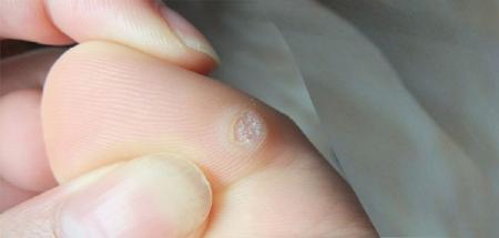 رفع میخچه به روش طب سنتی