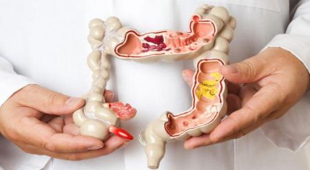تحول در تشخیص و درمان سندرم روده تحریک‌پذیر