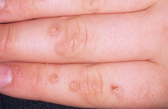 ۳۰ درمان خانگی که زگیل را برای همیشه از بین ببرید