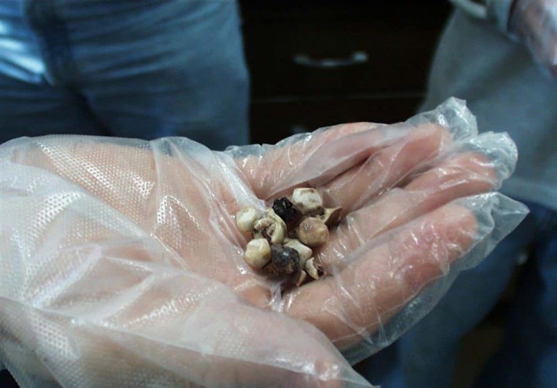 نسخه طب سنتی برای تسکین درد سنگ کیسه صفرا 