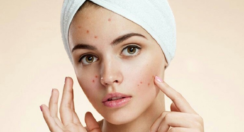 جای جوش را چگونه محو کنیم؟