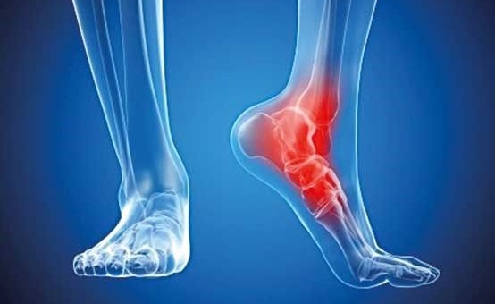 خار پاشنه یکی از رایج‌ترین علل درد پاشنه پا است که به علت التهاب رباط کف...