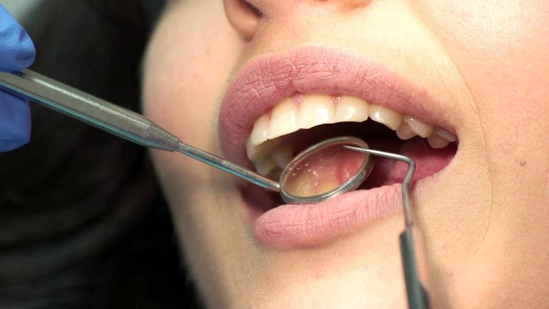 ظاهر شدن لکه های سفید روی دندان چه دلایلی دارد؟