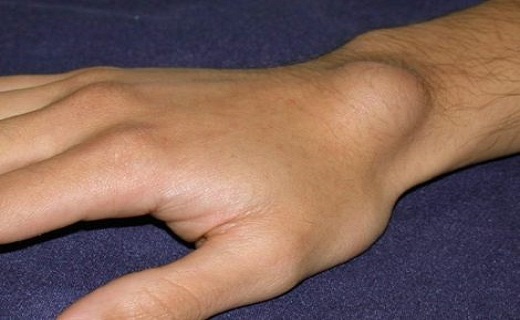  کیست‌های دردناکی که روی دست ظاهر می‌شوند