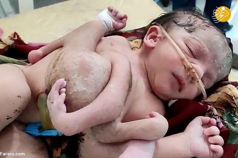 تولد نوزاد د‌ختر با ۴ پا و ۳ دست + عکس