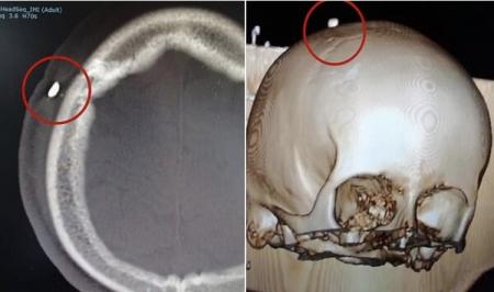 خروج دندان از جمجمه بازیکن جوان + عکس