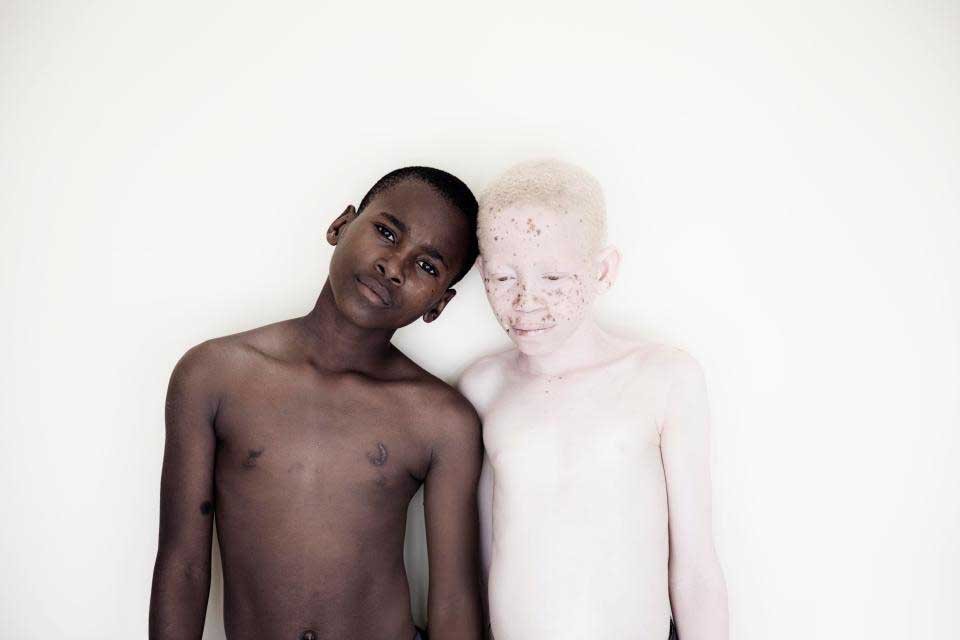  باوری عجیب در میان مردم تانزانیا درباره کودکان مبتلا به زالی + عکس
