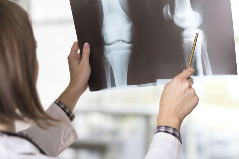 شایع‌ترین شکستگی در زنان بالای ۴۰ سال چیست؟