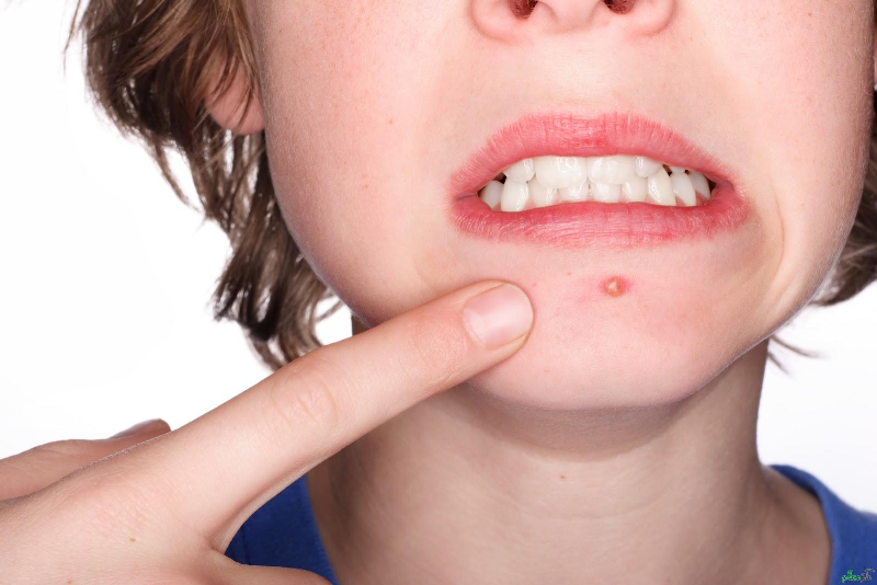 آیا جوش زدن مسری است؟