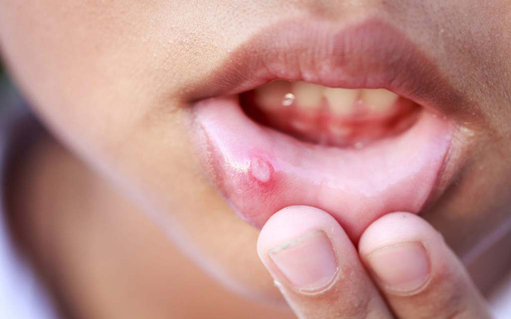 طب سنتي براي درمان آفت دهان چه توصيه هايي دارد؟