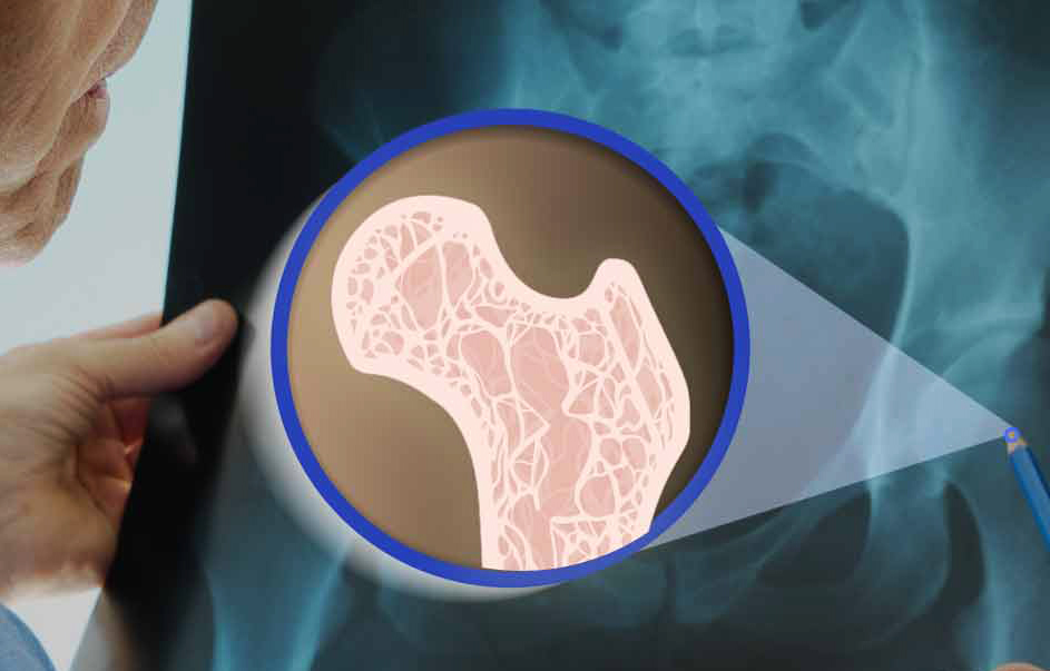  پیشگیری و درمان پوکی استخوان در پنج قدم 