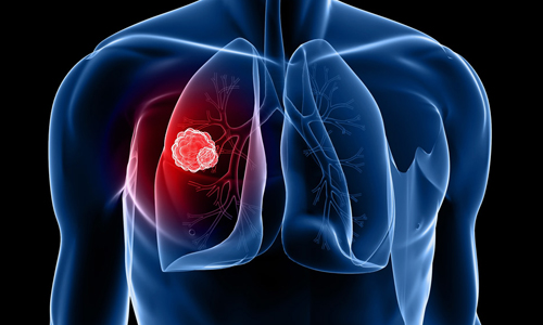 راه های جلوگیری از سرطان ریه و نشانه های ابتلا به سرطان ریه